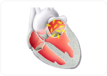 Ürək ritm pozuntuları